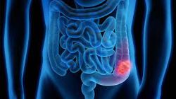 Braftovi Regimen Is Promising in Metastatic Colorectal Cancer