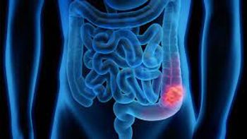 Illustration of a person's intestines, with the rectum in red. 