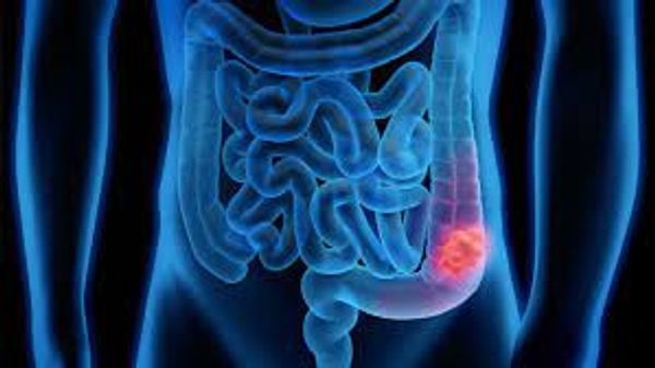 rectal cancer