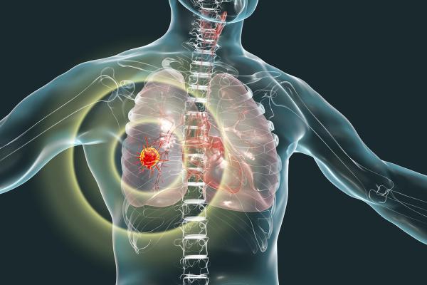 lung cancer