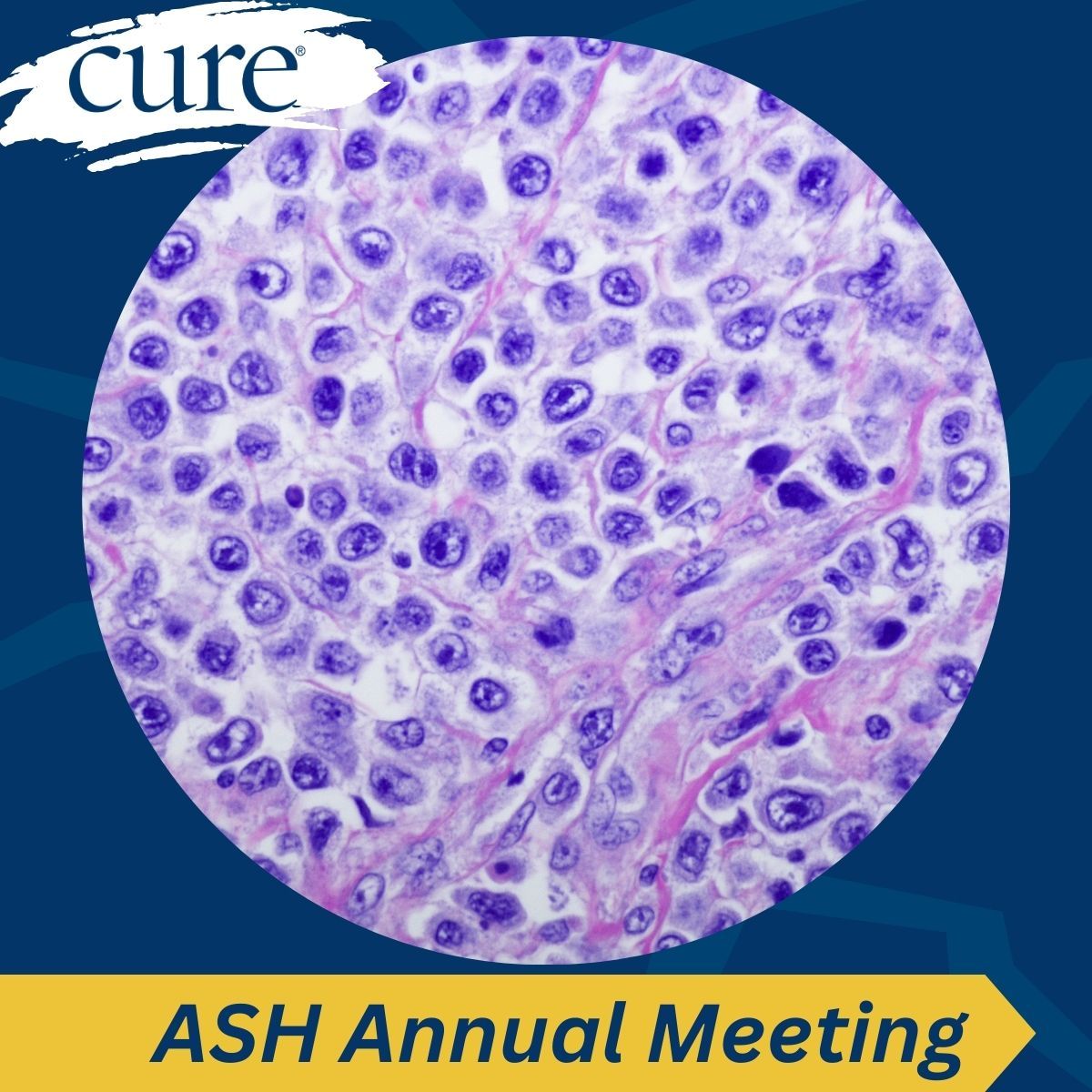 Older Patients With DLBCL May Benefit From First-Line Epkinly Plus R-mini-CHOP