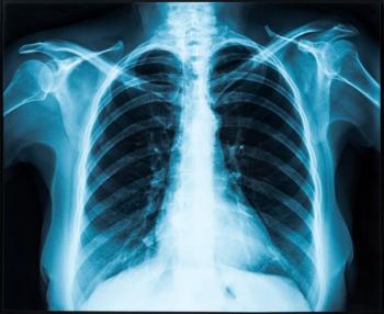 Chest X-ray