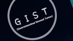 Gastrointestinal Stromal Tumor: Comprehensive Patient Guide