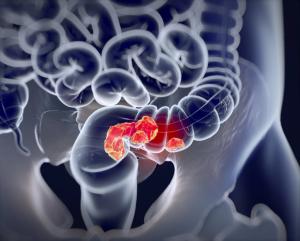 Early-Onset Colorectal Cancer Is Not Distinguishable From Average-Onset CRC