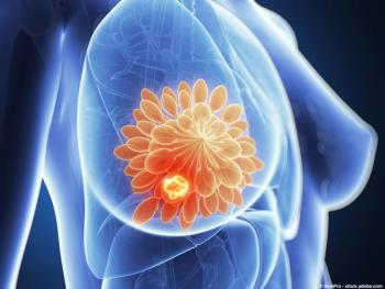 Image of breast cancer.