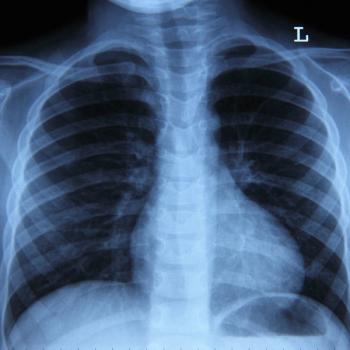 Image of lung cancer.