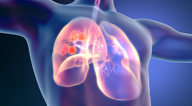 lung cancer