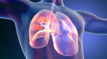 lung cancer