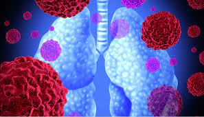 image of lung cancer