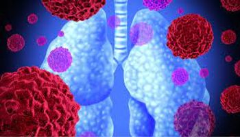 image of lung cancer