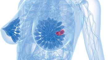 Talazoparib Beats Chemo in BRCA-Positive Breast Cancer 