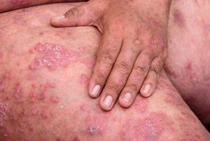 Risankizumab outperforms secukinumab at one year