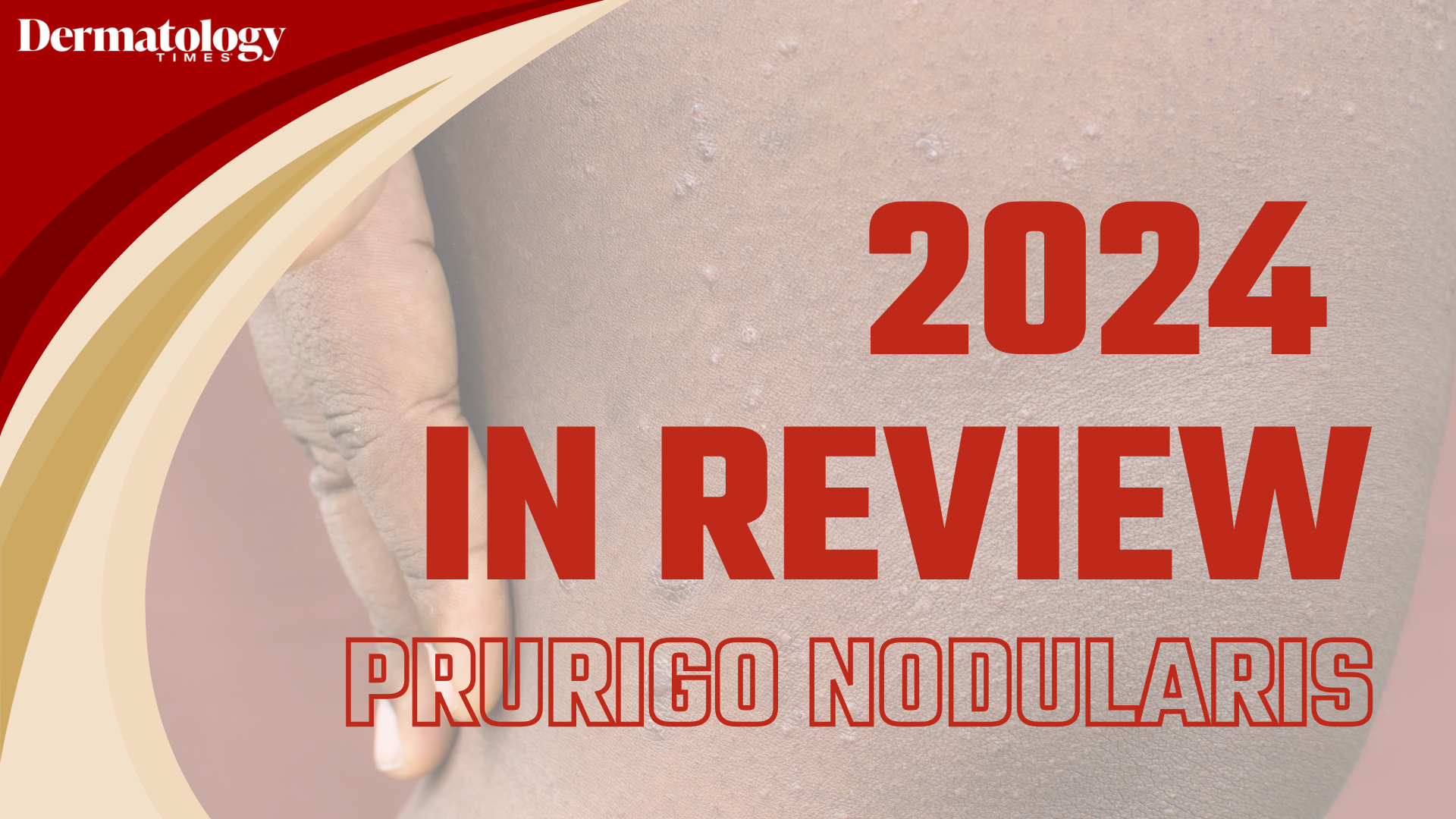 Dermatology Times 2024 In Review: Prurigo Nodularis