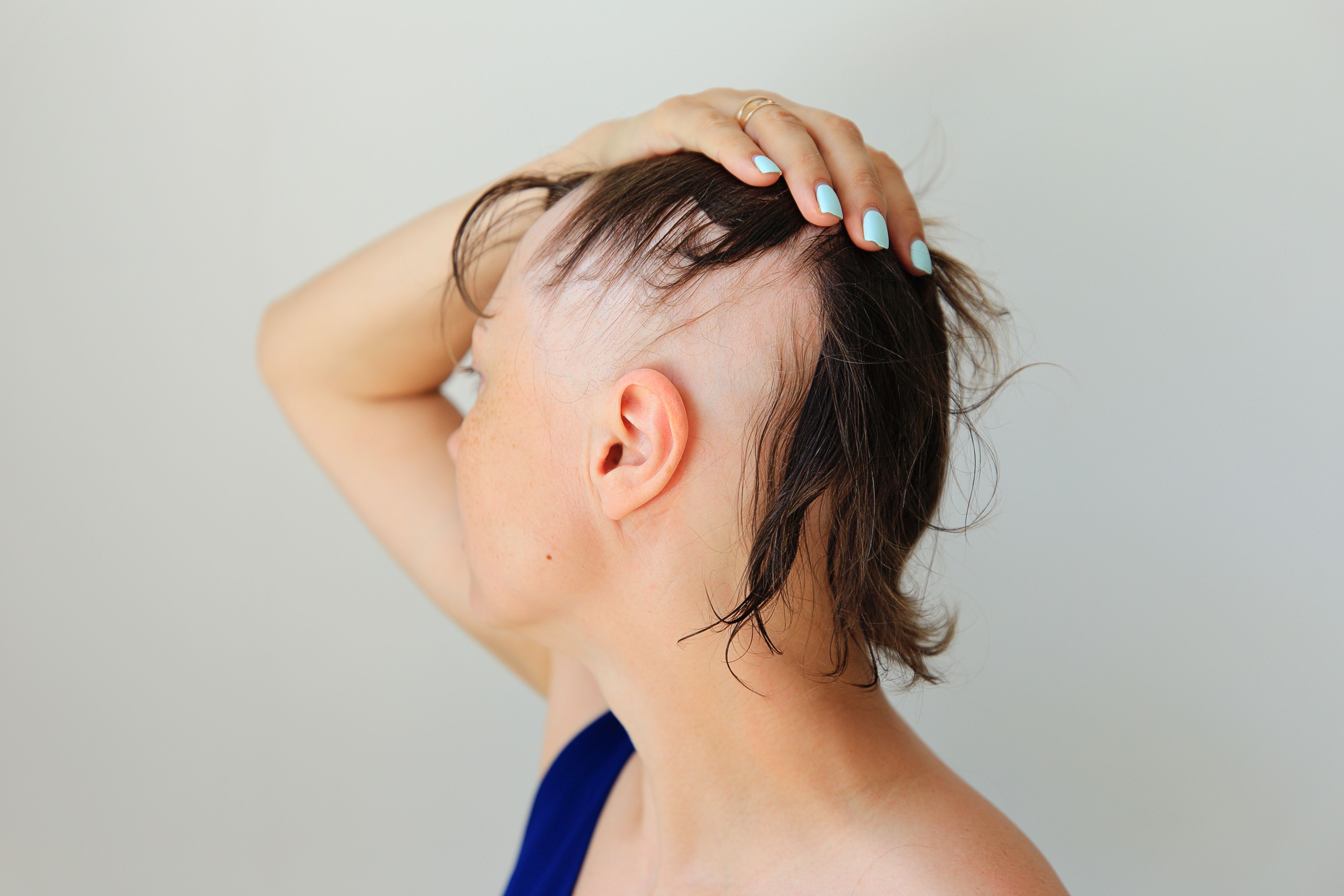 An Updated in the Management of Alopecia Areata | IntechOpen