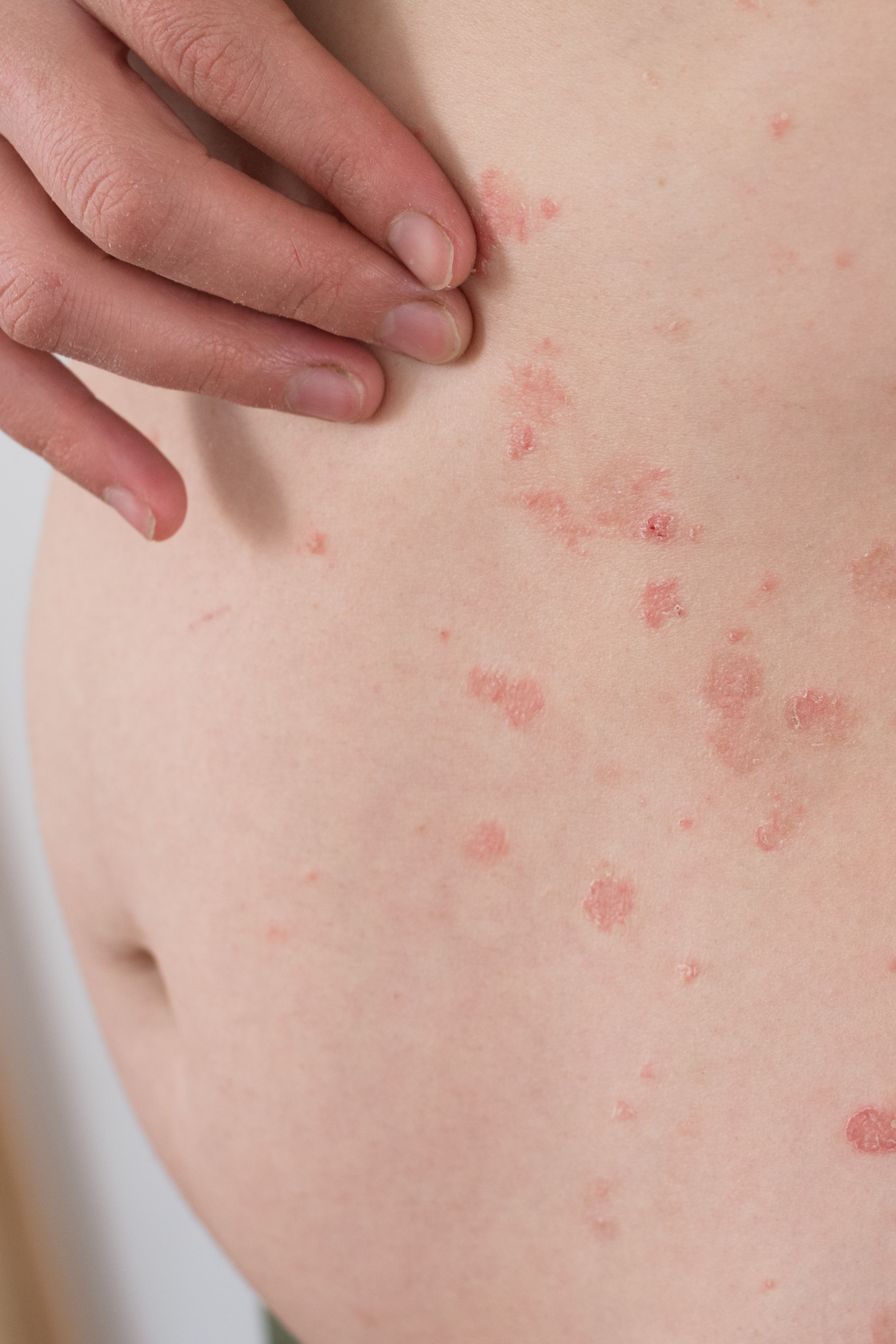 Understanding Family Planning Concerns in Patients with Psoriasis