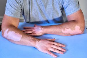 The Other JAK Inhibitors for Vitiligo