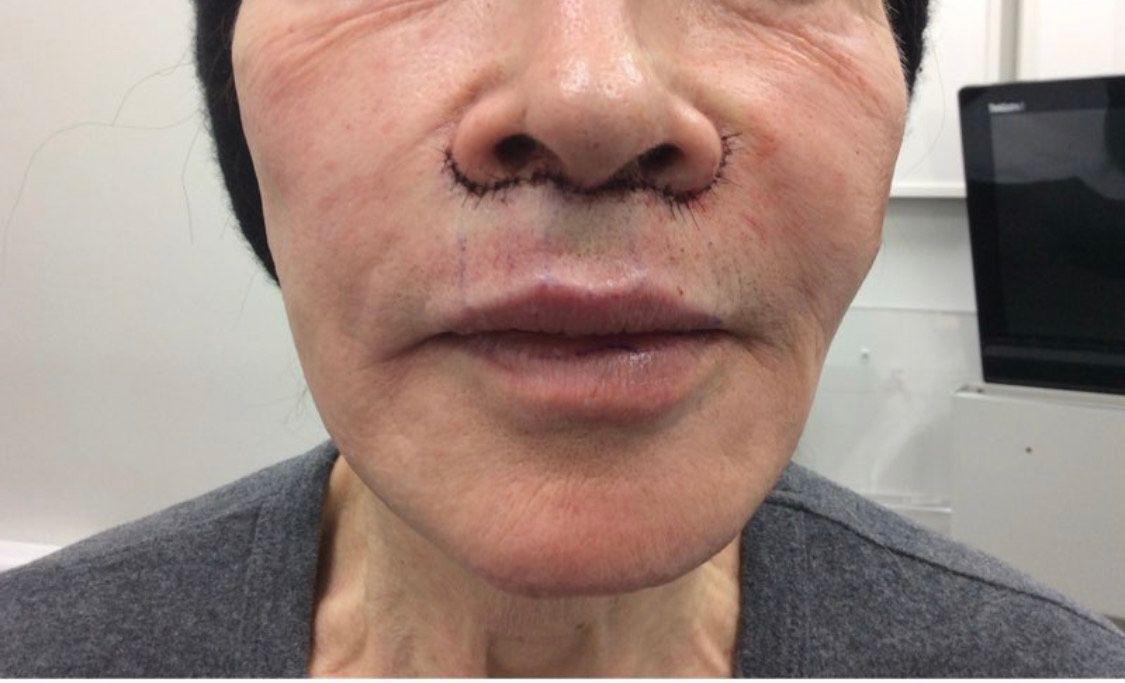 subnasal lip lift