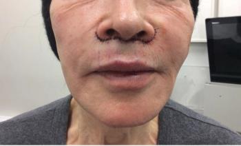 subnasal lip lift