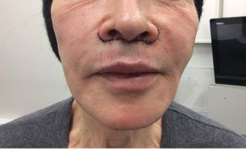 subnasal lip lift