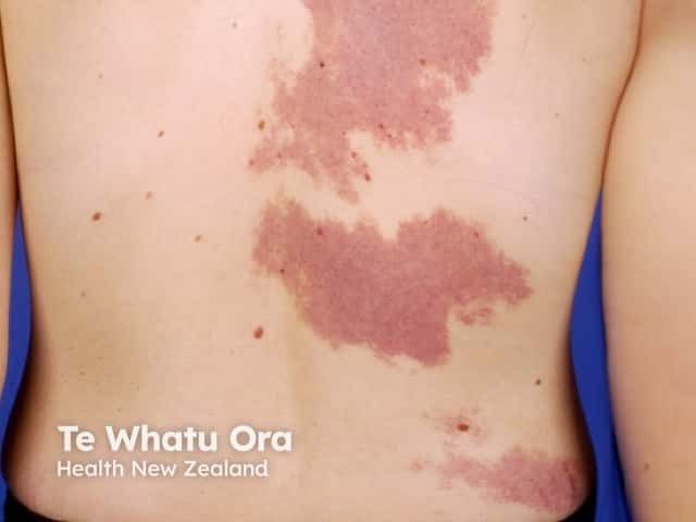 Rose Birthmark Large-Spot, Variable-Pulsed KTP Laser Demonstrates Safety and Efficacy ...