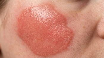 Daxdilimab Improves Disease Activity in Treatment-Refractory Discoid Lupus in Phase 2 Trial