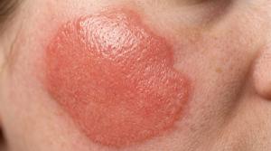 Daxdilimab Improves Disease Activity in Treatment-Refractory Discoid Lupus in Phase 2 Trial