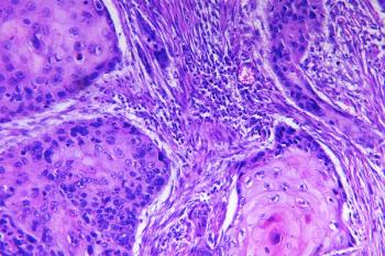 Squamous Cell Carcinoma