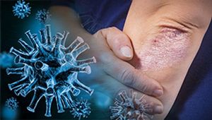 COVID-19 study shows impact on patients with PsO, other autoimmune problems