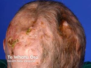 Gorlin syndrome