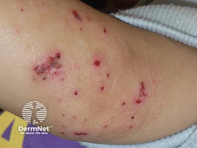 Cold Therapy May Relieve Inflammation in AD