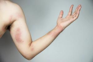 Deep Dive into Inflammatory Skin Disease