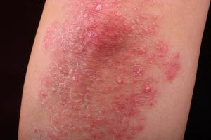 Solve the Challenges of Mild to Moderate Psoriasis 