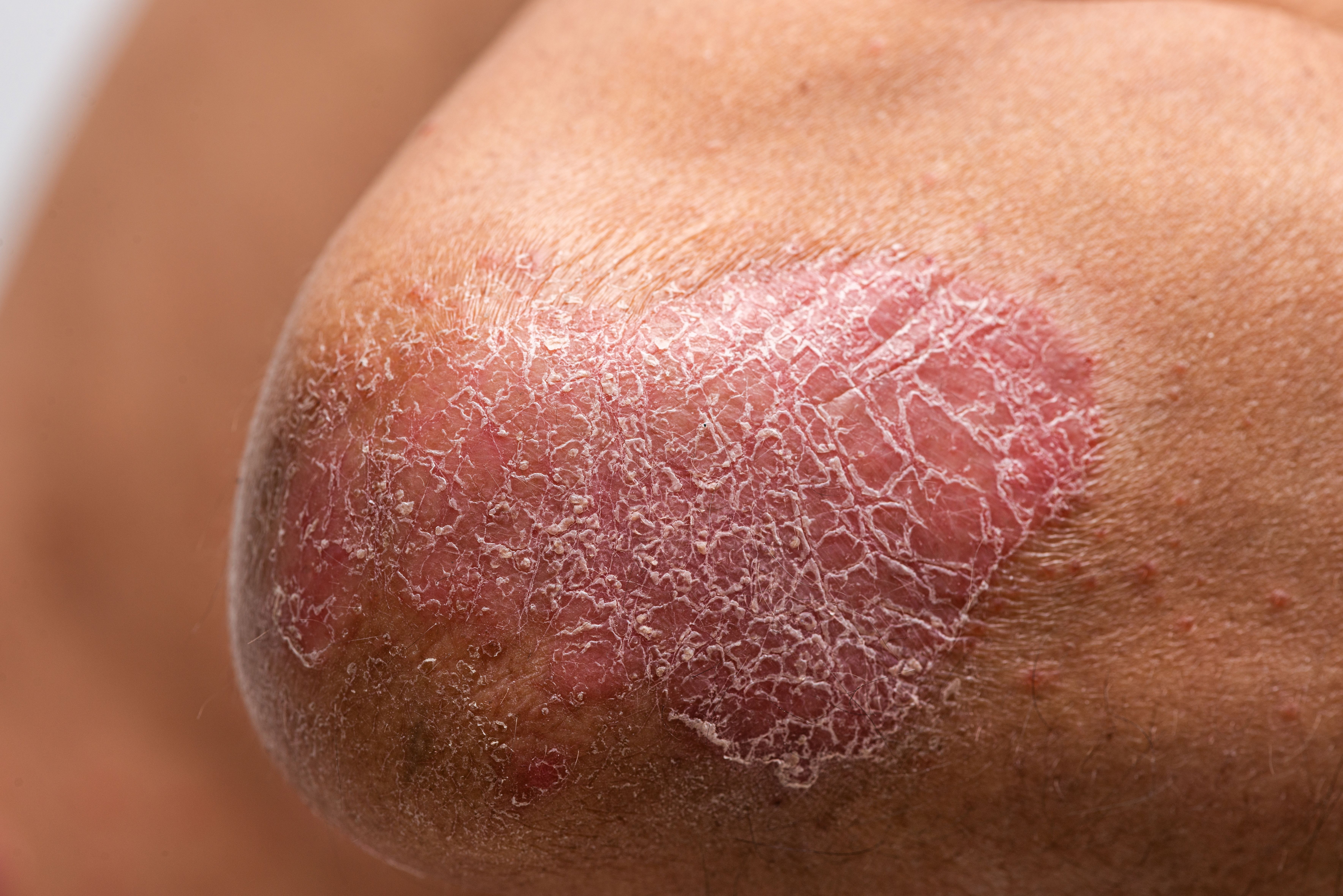 Review Compares Psoriasis Therapies in Asian Populations