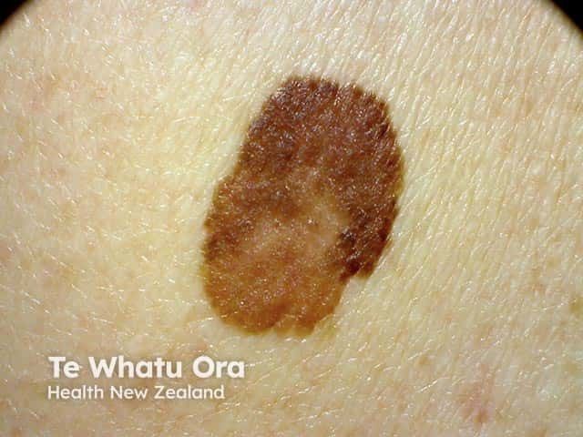 <![CDATA[The Power of the Partner: A Case Study on Secondary Melanoma Detection in Skin of Color]]>