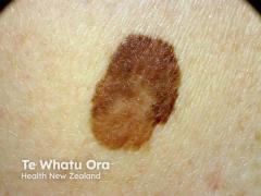 The Power of the Partner: A Case Study on Secondary Melanoma Detection in Skin of Color
