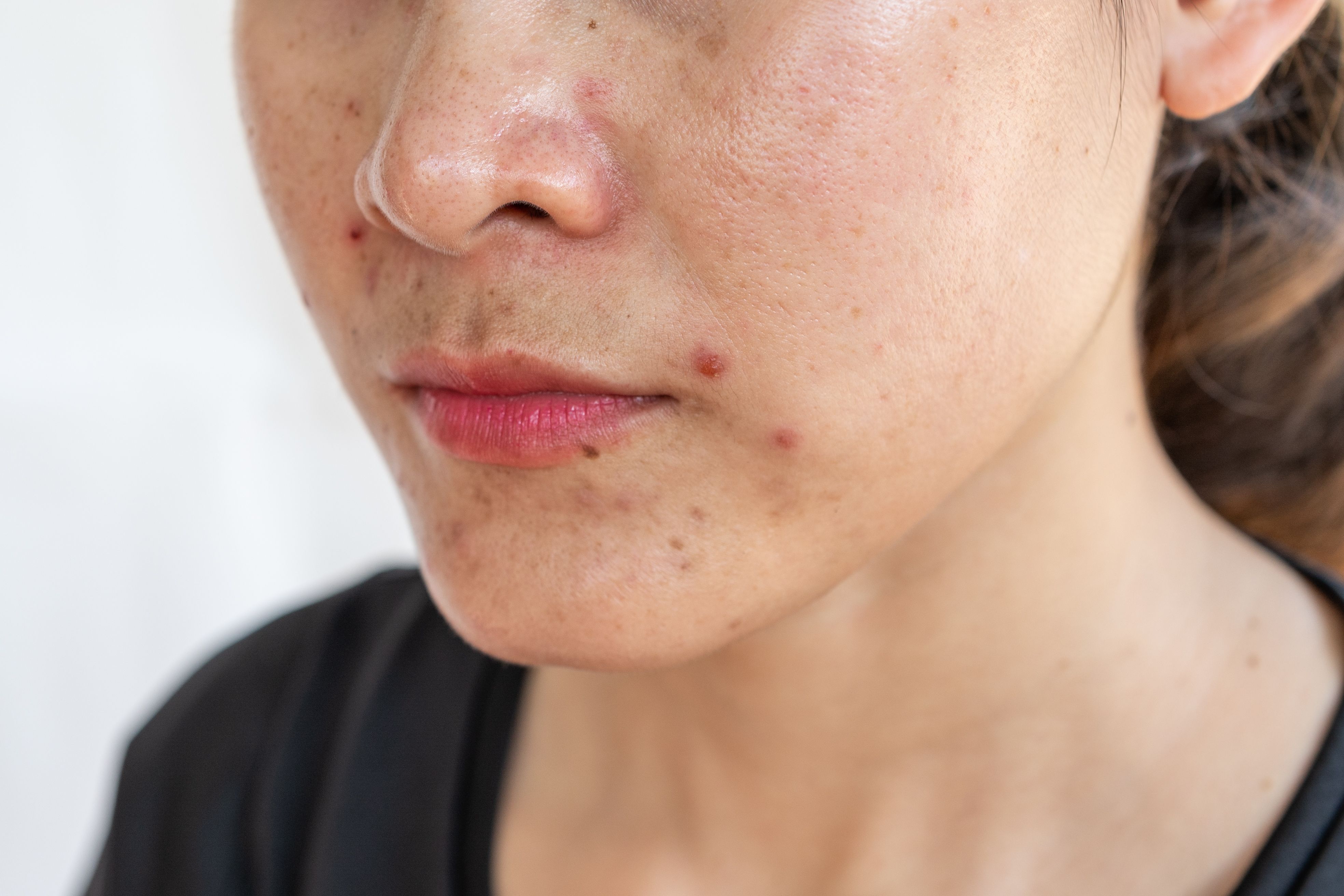 Understanding Isotretinoin's Anti-Inflammatory Mechanism Through Cytokine Levels