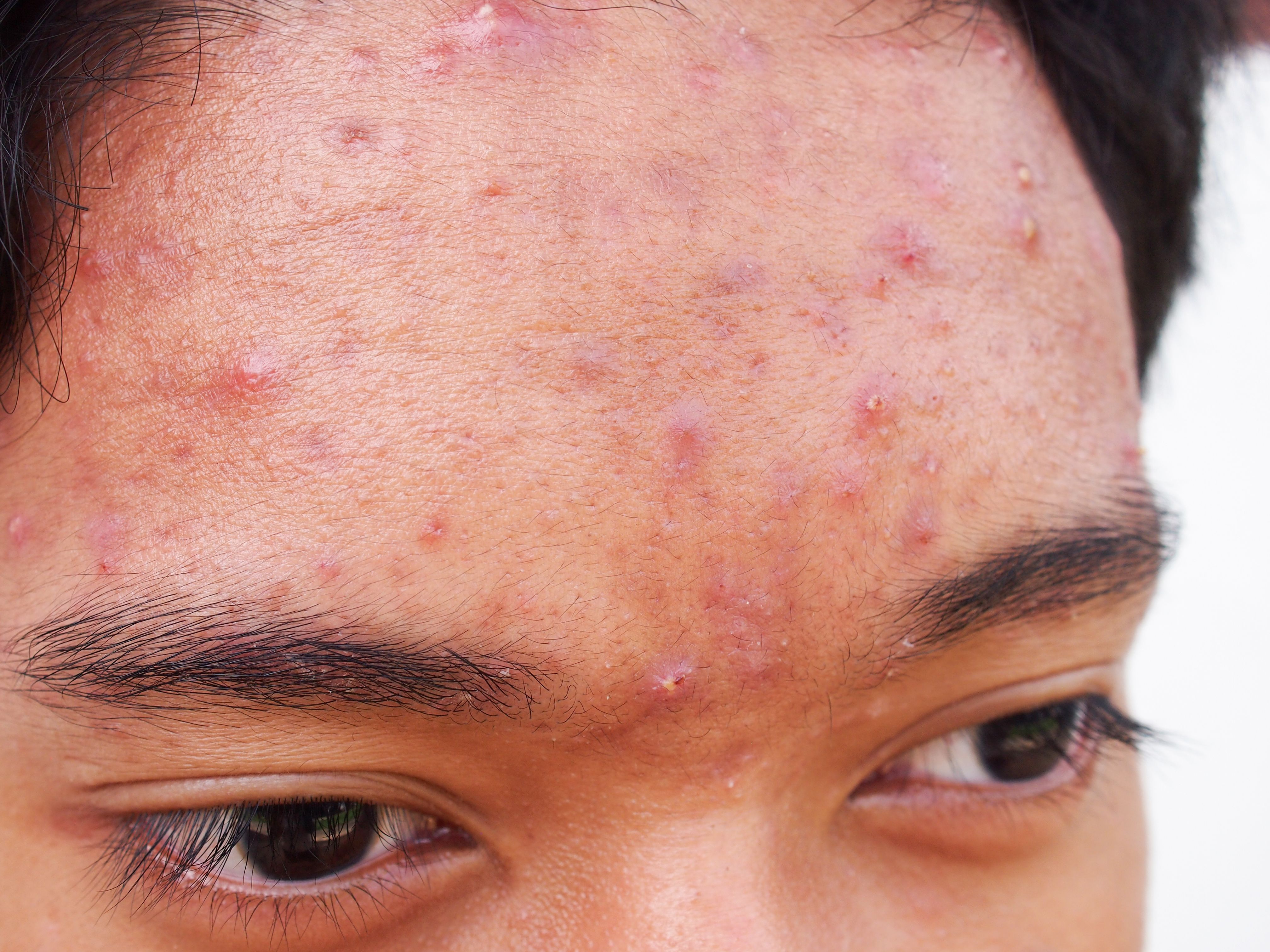 Acne Treatment Insights From SDPA Fall