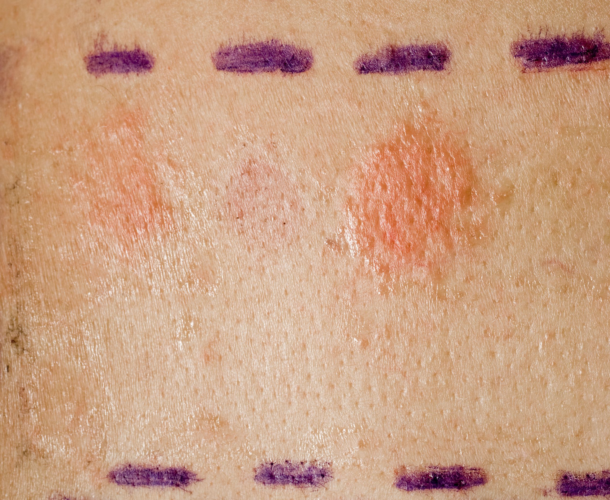 patch-testing-for-contact-dermatitis-and-biomedical-devices-allergens