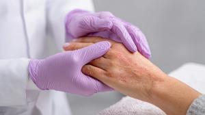 How Dermatologists Can Incorporate GLP-1 Receptor Agonists Into Psoriasis Care
