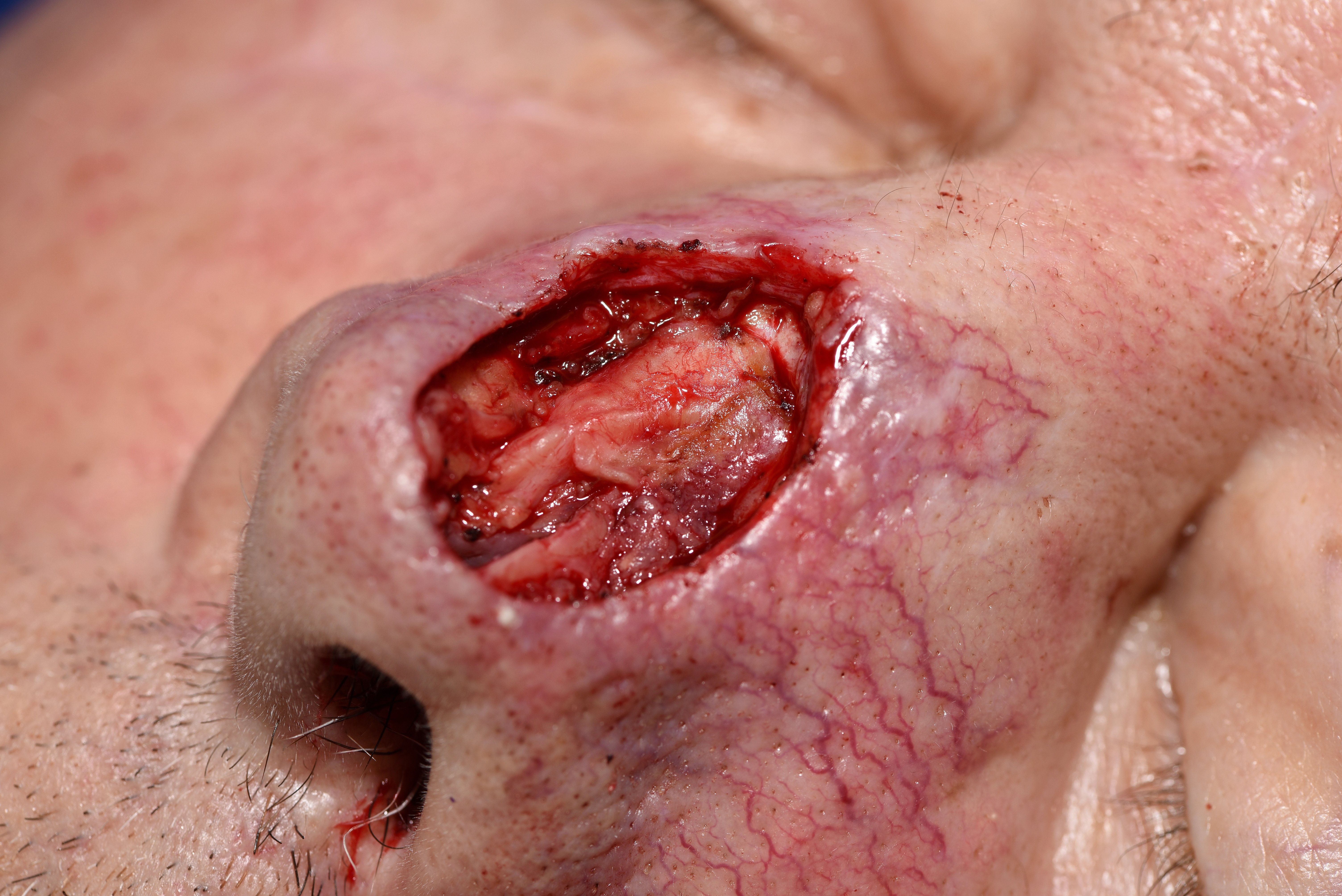nose wound