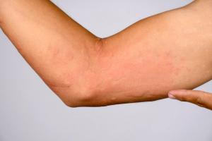 Stapokibart Successfully Treats Refractory CSU After Omalizumab Failure in New Case Report