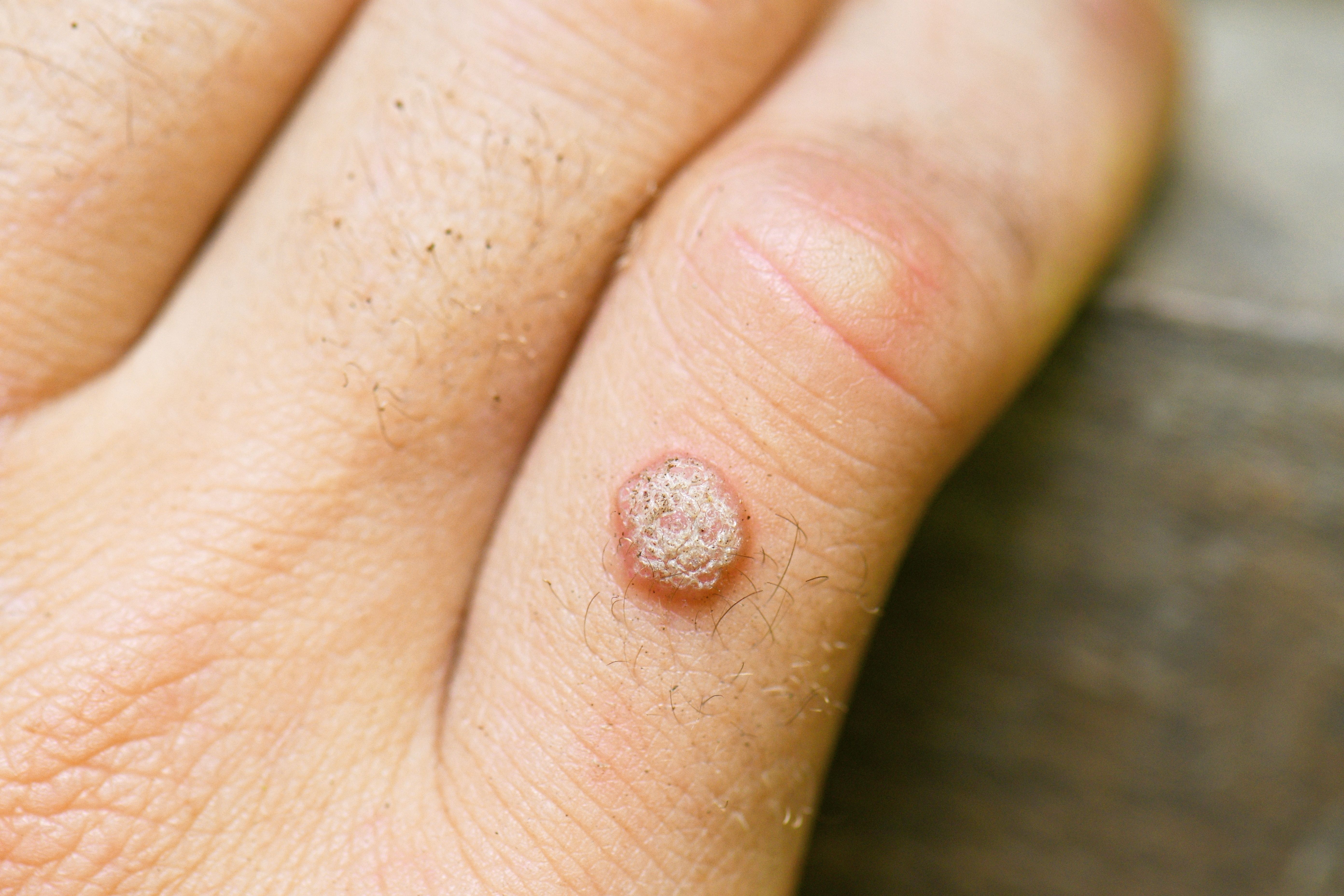 wart remover on skin cancer