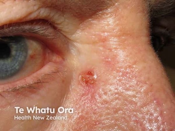 Photodynamic Therapy for sBCC Advances to FDA Review