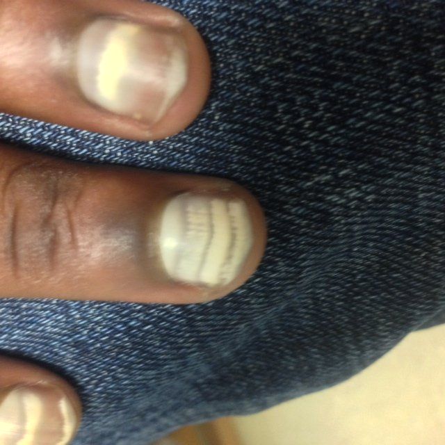 Nail discoloration could be a red flag