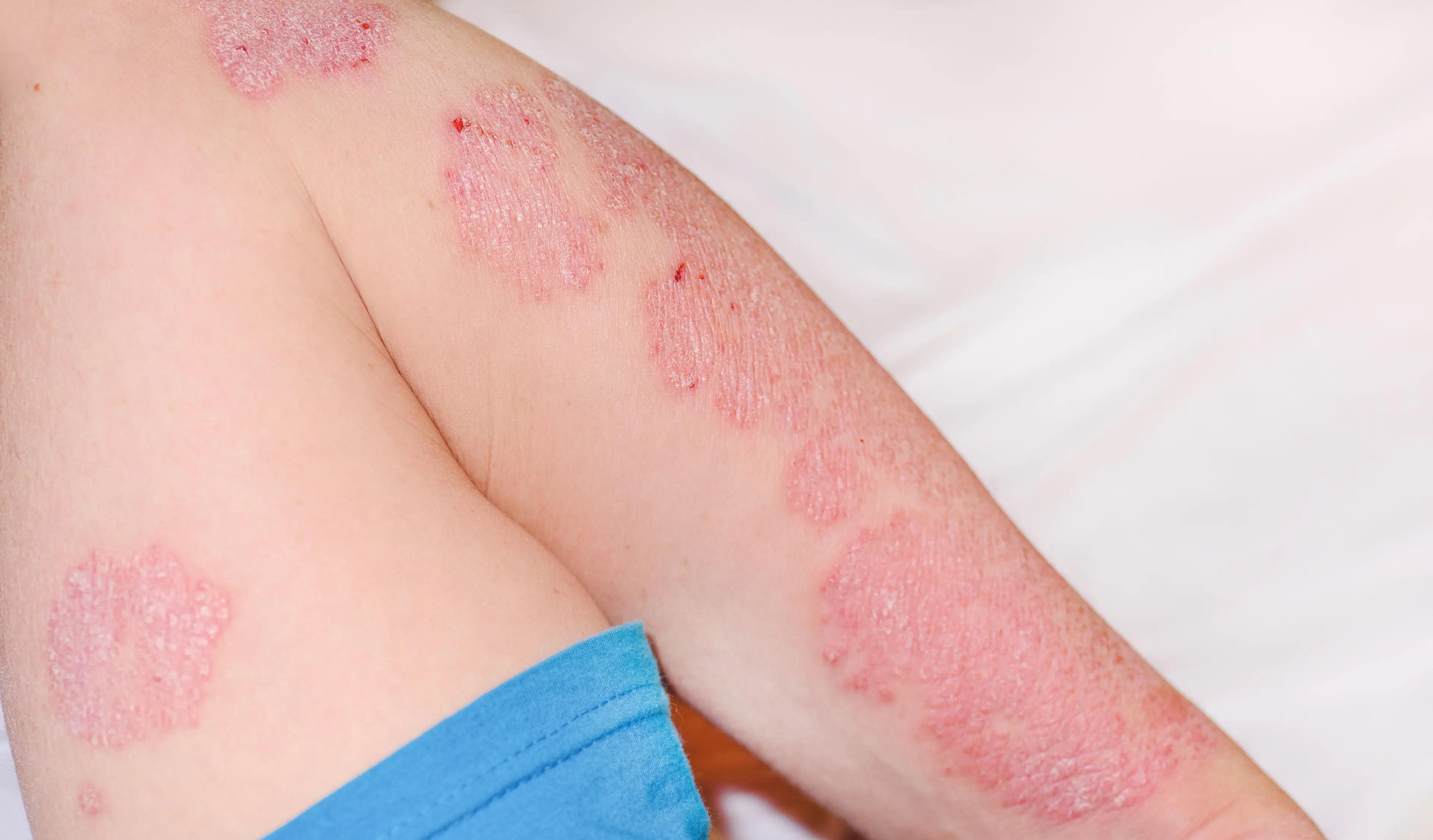 Arcutis Submits sNDA for Roflumilast Cream 0.3% to Treat Plaque Psoriasis in Patients as Young as 2
