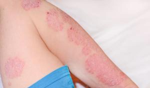 Arcutis Submits sNDA for Roflumilast Cream 0.3% to Treat Plaque Psoriasis in Patients as Young as 2