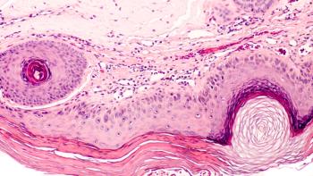 actinic keratosis