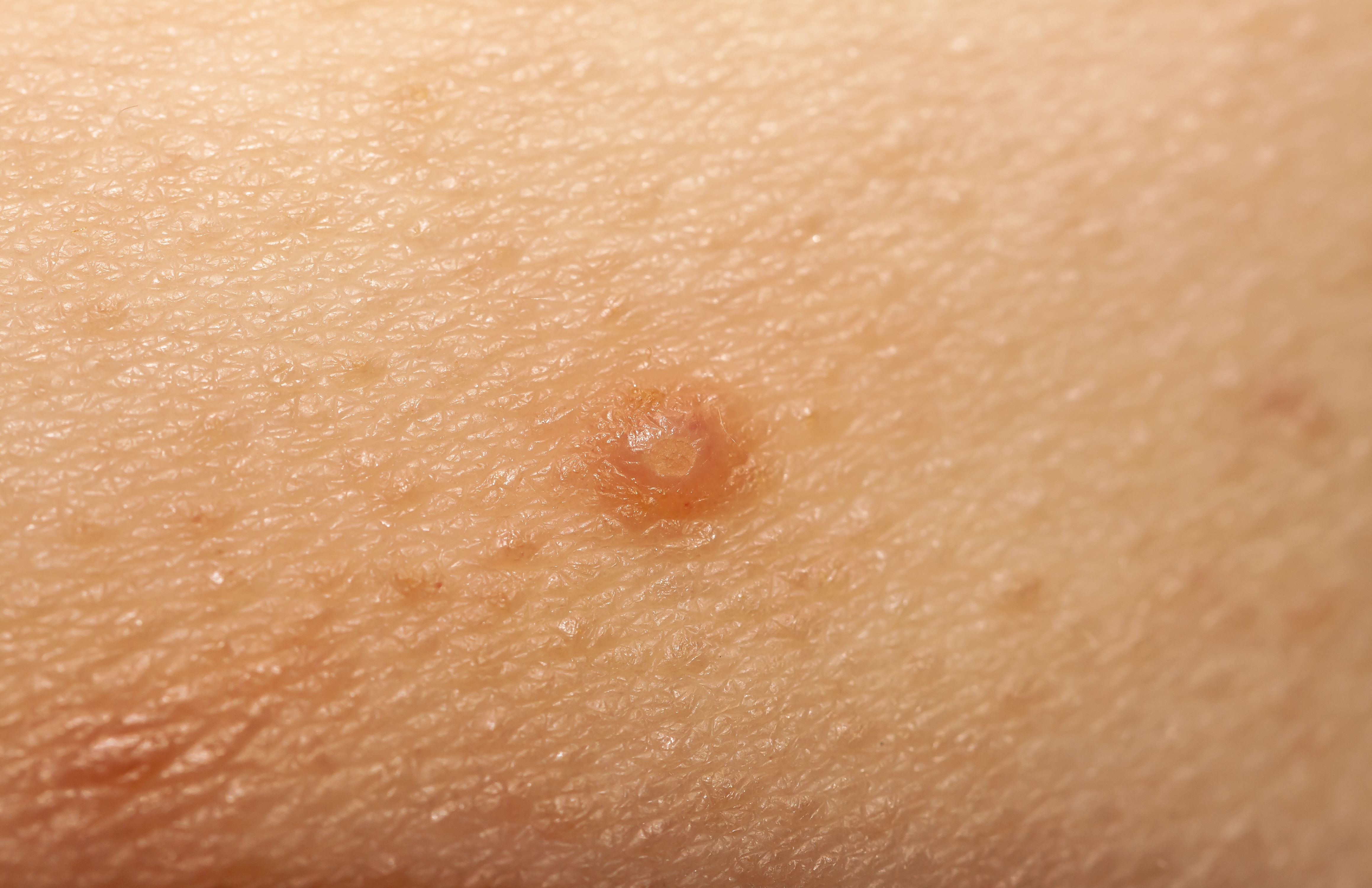 Topical Cantharidin Shows Efficacy Safety For Molluscum Contagiosum Treatment 