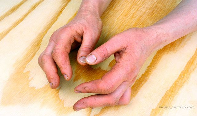 psoriatic arthritis