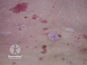 SkinJect Advances into Registrable Development as Potential First-in-Class Therapy for Gorlin Syndrome
